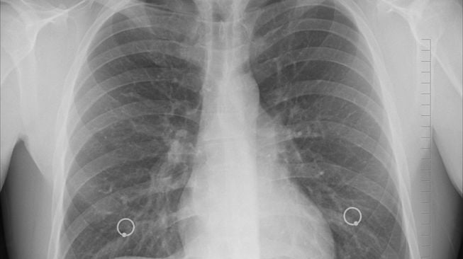 6 Kasus Pneumonia Mycoplasma Ada di RI, Kemenkes Tidak Tutup Kemungkin Adanya Pandemi Baru