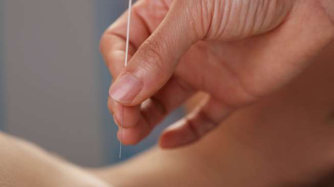 2 Manfaat Terapi Akupuntur Usai Serangan Stroke, Bisa Cegah Kecacatan?